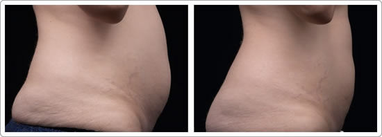 vaser shape cellulite reduction before & after photos