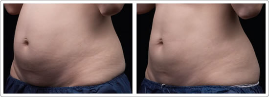 cellulite reduction boston