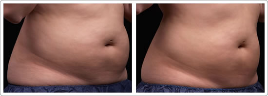 cellulite reduction treatments boston